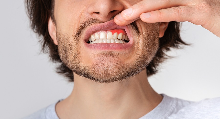 What Are the Causes of Gum Disease?