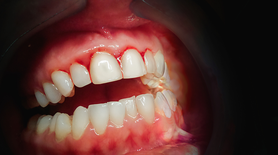 Understanding Gum Disease & Treatment: A Path to Healthy Gums and Smile